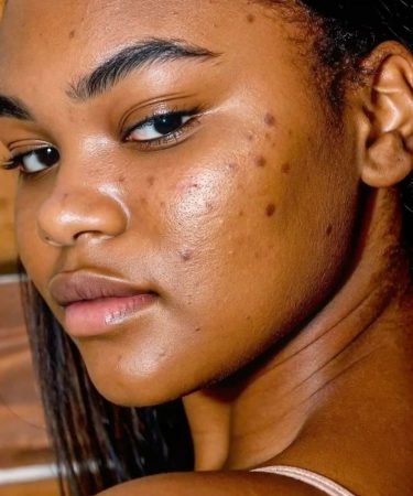 Femme avec des points noirs crédit photo: @pinterest