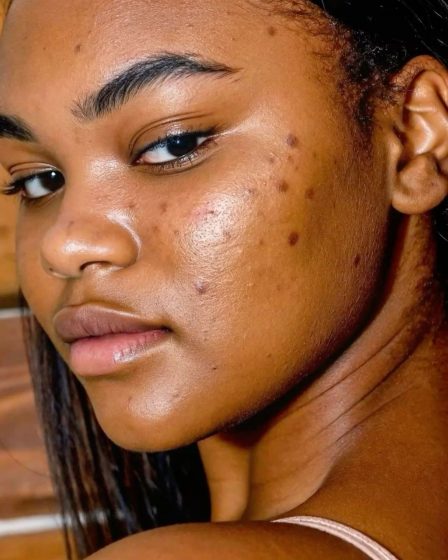 Femme avec des points noirs crédit photo: @pinterest